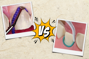 What is Retraction Paste? And How Does it Compare to Packing Cord?