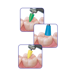 NTi CeraGlaze Polishers